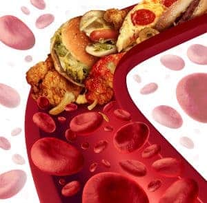 cholesterol blokovana tepna